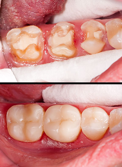 Astoria Modern Family Dental | Dental Lab, Implant Restorations and Emergency Treatment