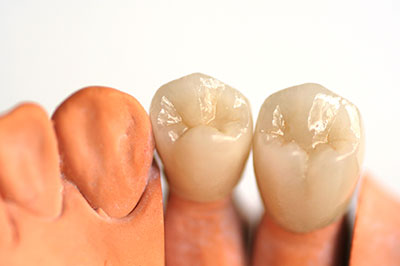 Astoria Modern Family Dental | Dental Bridges, Extractions and Implant Dentistry