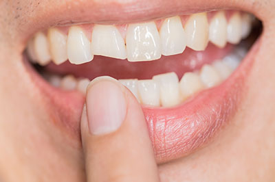 Astoria Modern Family Dental | Preventative Program, Ceramic Crowns and Teeth Whitening