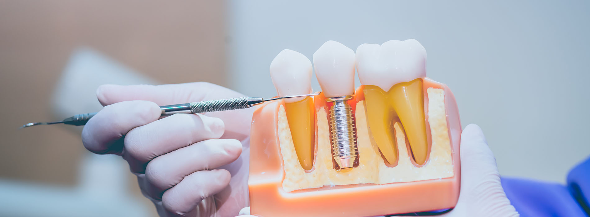 Astoria Modern Family Dental | Inlays amp Onlays, Root Canals and Emergency Treatment